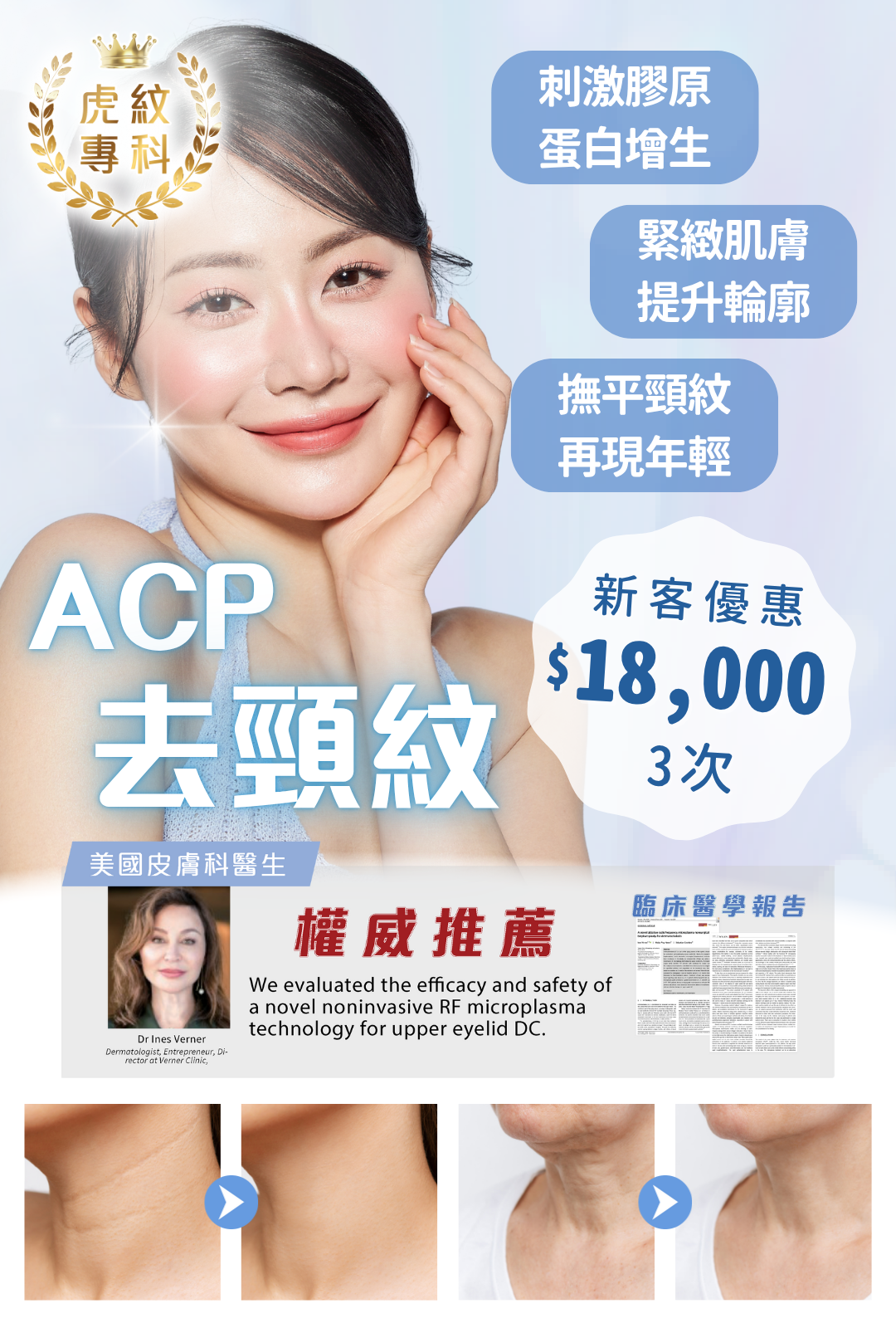 ACP 去頸紋