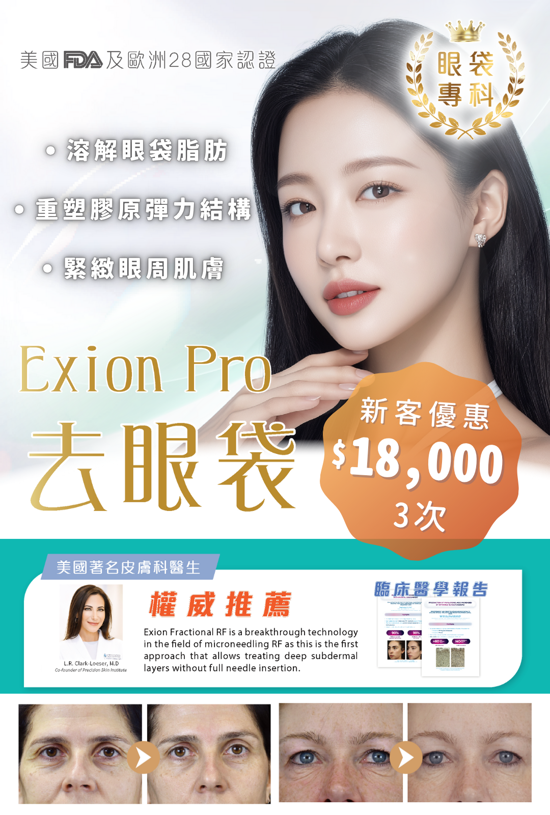 Exion Pro 去眼袋