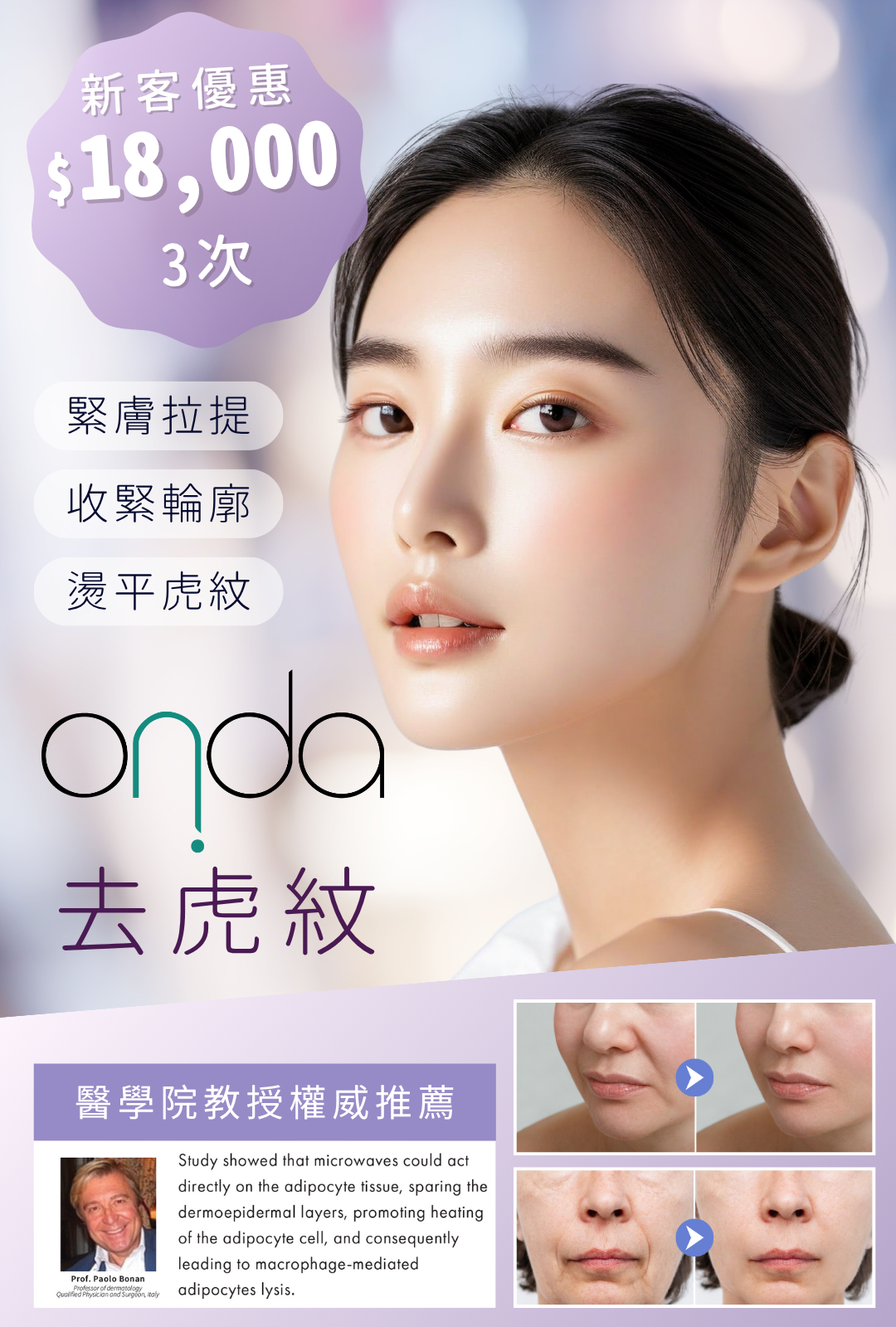 Onda 去虎紋