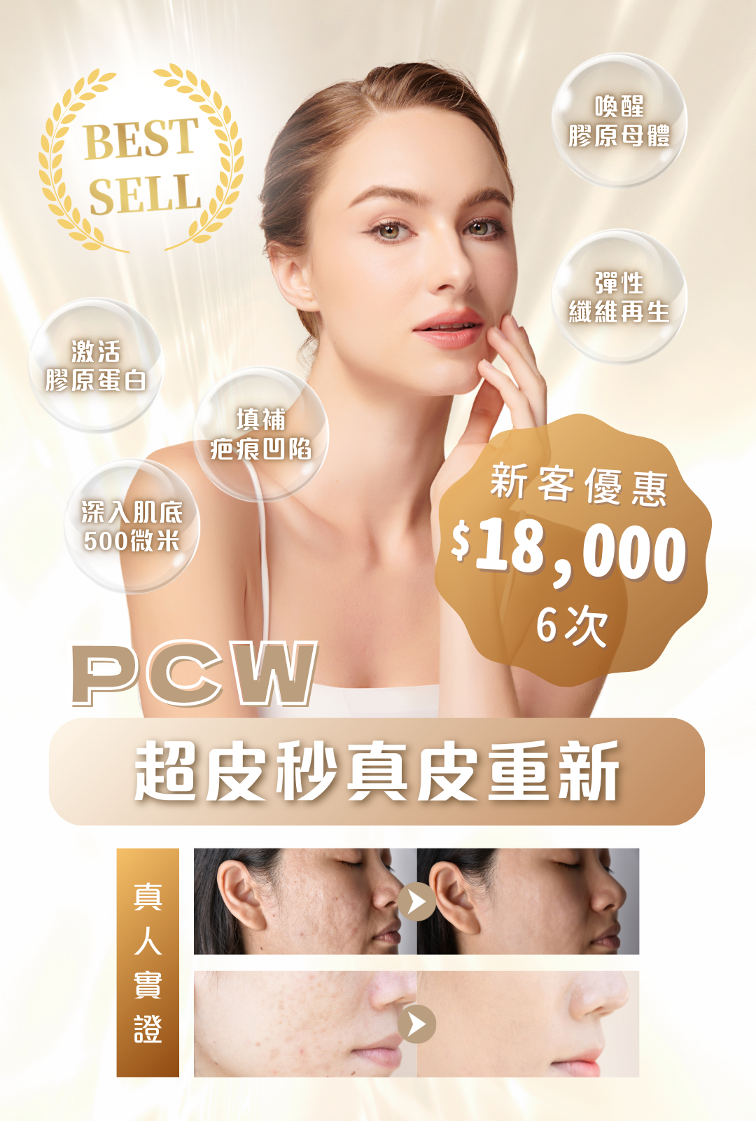 PCW超皮秒真皮重新