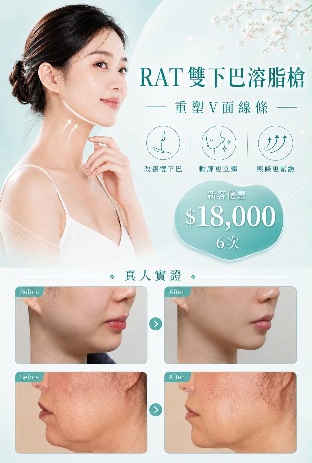 RAT雙下巴溶脂槍